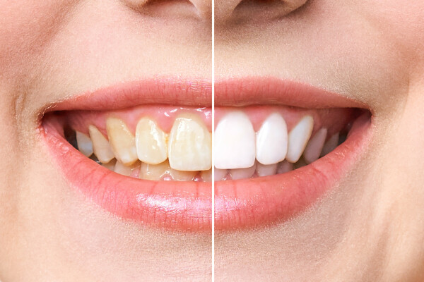 witte tanden before after