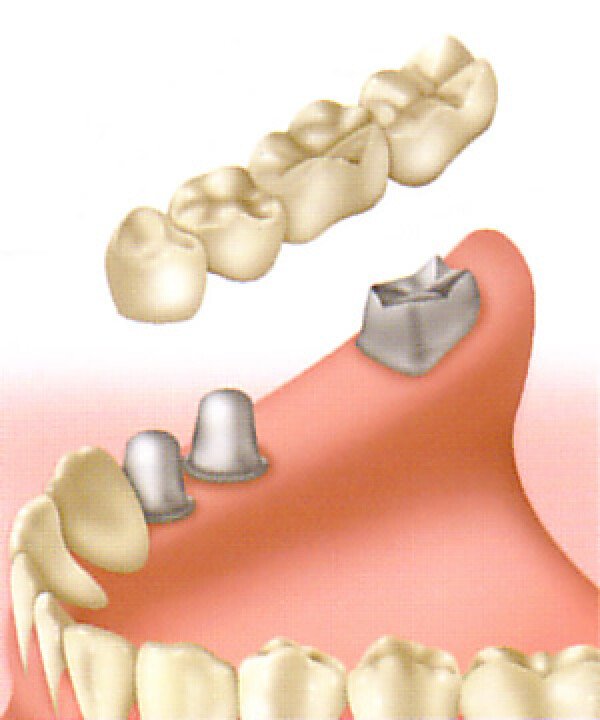 4deligebrug op 2implant