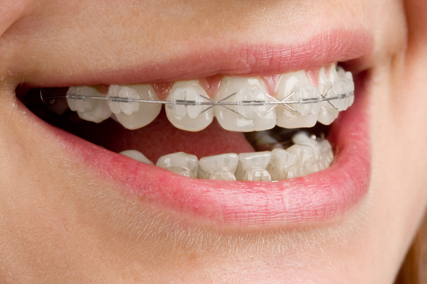 Brackets