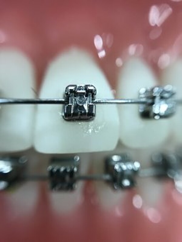 ortho brackets